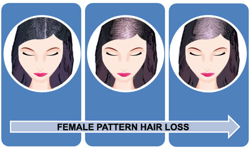 Figure10_FemalePatternHairLossi