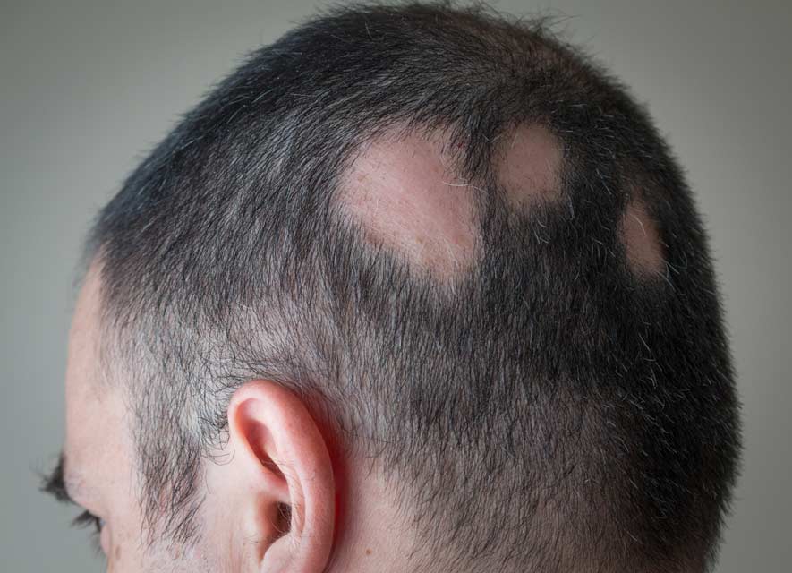 Alopecia Areata Typically alopecia areata presents as patchy hair loss.