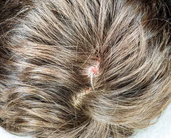 Folliculitis Decalvans Folliculitis decalvans is a rare disorder that causes scalp lesions and permanent hair loss.