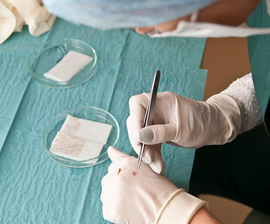 Hair Implants Hair transplant surgery is a successful way to treat hair loss in many patients with thinning hair.