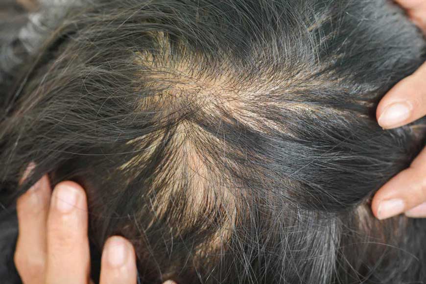 Herbs and Nutrients to Avoid if Balding If you have female pattern hair loss, avoid these supplements.