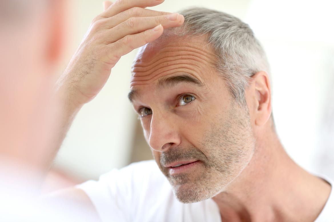Male Pattern Hair Loss What does common male balding look like?